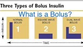 Medtronic Insulin Pump Questions  Bolus [upl. by Leihcey]