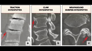 Osteophytes Bone Spurs  Definition causes Symptoms Diagnosis Treatment [upl. by Nagy]