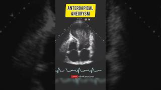 Large Anteroapical Aneurysm  Echocardiography For Beginners cardiology echocardiogram [upl. by Najar]