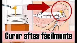 10 remedios naturales para tratar las úlceras bucales [upl. by Hanas672]