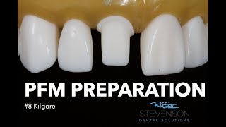 PFM Preparation for 8 Kilgore  Stevenson Dental Solutions [upl. by Philippe]