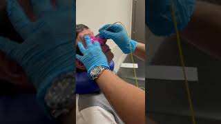 MicroPulse Laser Glaucoma Treatment by ProfZilfyan [upl. by Rosaleen602]