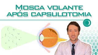 Mosca volante após capsulotomia com YAG laser [upl. by Hey]