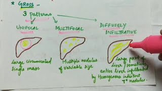 Hepatocellular Carcinoma HCC  Pathology  Handwritten notes [upl. by Wettam697]