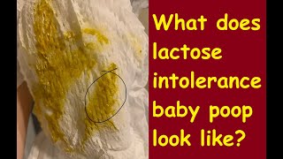 What does lactose intolerance baby poop look like [upl. by Nella]