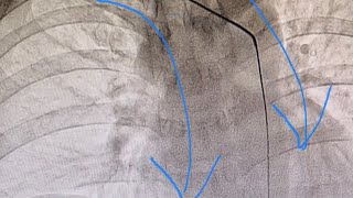 Taking A Deep Breath May Straighten The Right Subclavian ArteryAscending Aorta Curve [upl. by Sanjay]