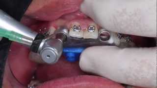 Implantes Dentales Procedimiento  Mis Implants Colombia [upl. by Anod]