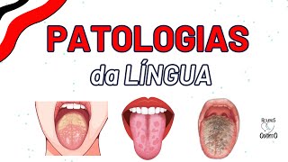 LIQUEN PLANO  LEUCOPLASIA ORAL  LÍNGUA FISSURADA PILOSA E GEOGRÁFICA [upl. by Gnoh]