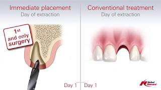 Immediate Placement vs Conventional Treatment Dental Implants [upl. by Oirazan]