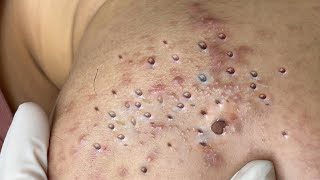 Big Cystic Acne Blackheads Extraction Blackheads amp Milia Whiteheads Removal Pimple Popping  4253 [upl. by Cherice]