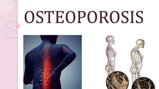 Osteoporosis Causes Symptoms Treatment [upl. by Cliff]