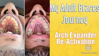 Braces My 1st adjustment arch Expander quotReActivationquot [upl. by Deth698]