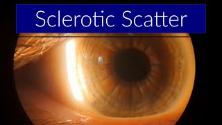 Sclerotic Scatter  Slit Lamp Techniques [upl. by Eelrebmyk335]