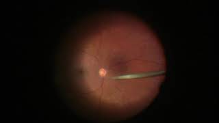 Endolaser Panretinal Photocoagulation PRP [upl. by Adis]