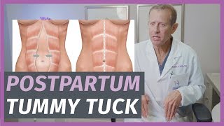 Postpartum Tummy Tucks Everything You Need To Know [upl. by Tserrof]