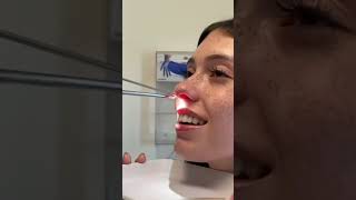 Rinoplastia  Retirando o Splint [upl. by Ariom]