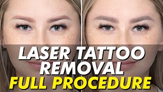 Laser tattoo removal for flawless brows  Permanent eyebrow makeup  Eye Design New York [upl. by Lynette]