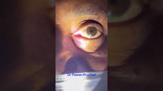 RAPD Relative Afferent Pupillary Defect [upl. by Larret229]