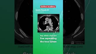 Aortic Dissection on CT Explained radiology [upl. by Assila]