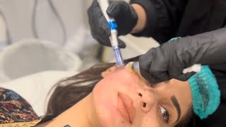 Face PRP Procedure  Benefits and side effects  Dr Shafaq [upl. by Eyram381]