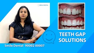 Teeth Gap Solutions smiledentalindia [upl. by Seften]