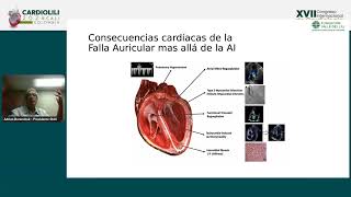 Atriopatía y fibrilación auricular  Adrián Baranchuk [upl. by Hazem]