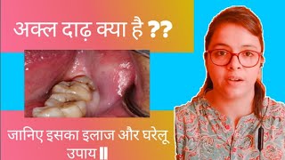 अक्ल दाढ़ क्या है  Wisdom tooth इलाज और घरेलू उपाय [upl. by Annekcm445]