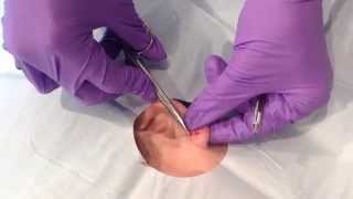 Cyst Excision  Surgical excision of a cyst on the earlobe [upl. by Avla]