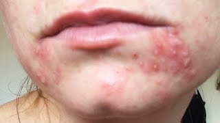 Dealing with Recurring Perioral Dermatitis [upl. by Savill]