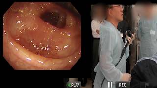 Live demonstrationcolonoscopy at AOMORI JAPAN2017Oct [upl. by Liebermann]