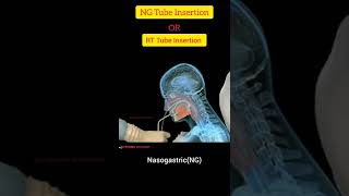 NG  Nasogastric  Tube Insertion Techniquen In Hindi ll RT Tube Insertion Procedure ll SG Pharma [upl. by Yuma]