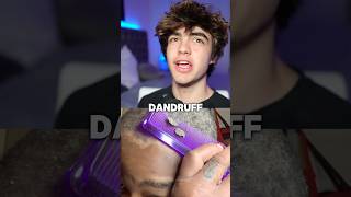 How to get rid of dandruff 😱🤝 [upl. by Jansson]