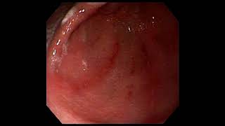 Gastroduodenitis withoesophageal candidiasis [upl. by Orfinger194]