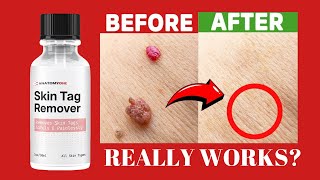 Anatomy One AnatomyOne Skin Tag Remover Reviews  Watch Before Buying [upl. by Yruy]