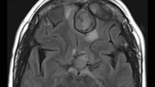 Intracranial Granulomatous Reaction [upl. by Adnilemreh]