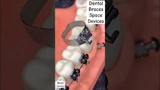 Dental Braces Space Devices [upl. by Enyaht]