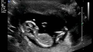 Cute baby fetus at 13 weeks  ultrasound [upl. by Hajar]