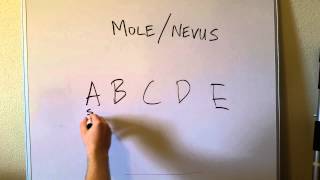 Introduction to a Mole Nevus and if its Melanoma [upl. by Malkah]