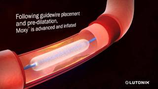 Angioplasty for Restenosis with Paclitaxel 3D Animation [upl. by Telrahc]