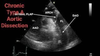 Chronic Type A Aortic Dissection CTAD Echocardiography post AVR [upl. by Tik]