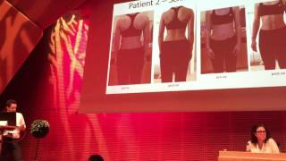 Clinical and radiological improvement of scoliosis with Schroth BSPTS exercises SOSORT Meeting 201 [upl. by Itnava509]