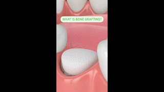 What is Bone Grafting [upl. by Nnylarak306]