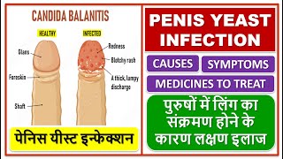 PENIS YEAST INFECTION TREATMENT पेनिस यीस्ट इन्फेक्शन लिंग का संक्रमण होने के कारण लक्षण इलाज [upl. by Nosydam893]