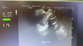 Endoscopic Ultrasound EUS guided FNAC of Pancreas Head TumorCancer [upl. by Dust940]