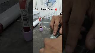 Prepare Perfect blood smear Blood film preparation Blood smear labor hematology laboratory [upl. by Atiuqaj]