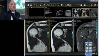 MRI Case Review Breaking All the Rules  Adhesive Capsulitis [upl. by Rand]