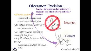 Olecranon fractures  1 of 2 [upl. by Zins516]