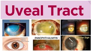 Uveal Tract 1 Major Topic Uveitus and its Classification [upl. by Neale]