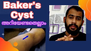 Bakers Cyst MalayalamSymptoms causesTreatment [upl. by Ednalrym]