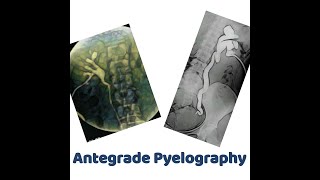 antegrade Pyelography [upl. by Fenwick593]